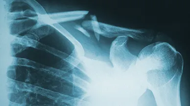 X-ray of broken bones.